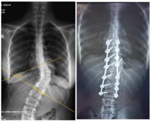 Congenital Scoliosis Correction in a 14-Year-Old Girl
