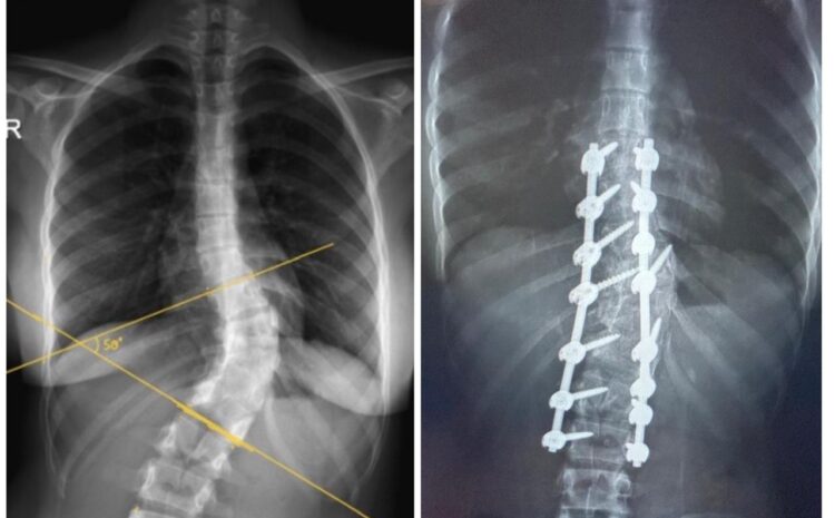 Congenital Scoliosis Correction in a 14-Year-Old Girl