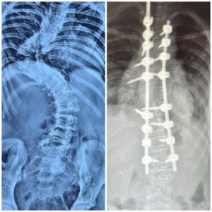Congenital Scoliosis Correction with Hemivertebra Excision