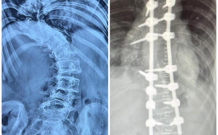 Congenital Scoliosis Correction with Hemivertebra Excision
