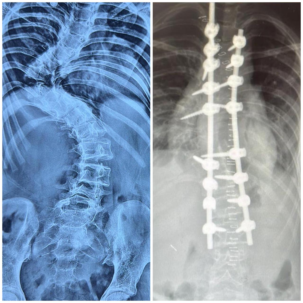 Acute Thoracic Curve Correction with Corpectomy and Laminectomy