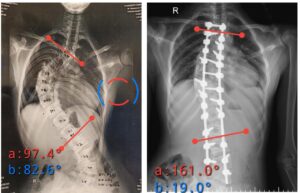 Case 3: 90° Spinal Curve Correction with Pedicle Subtraction Osteotomy