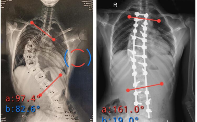 Case 3: 90° Spinal Curve Correction with Pedicle Subtraction Osteotomy