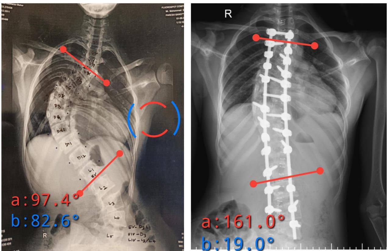 90° Spinal Curve Correction with Pedicle Subtraction Osteotomy